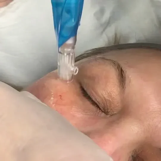Skin Needling Skin Needling